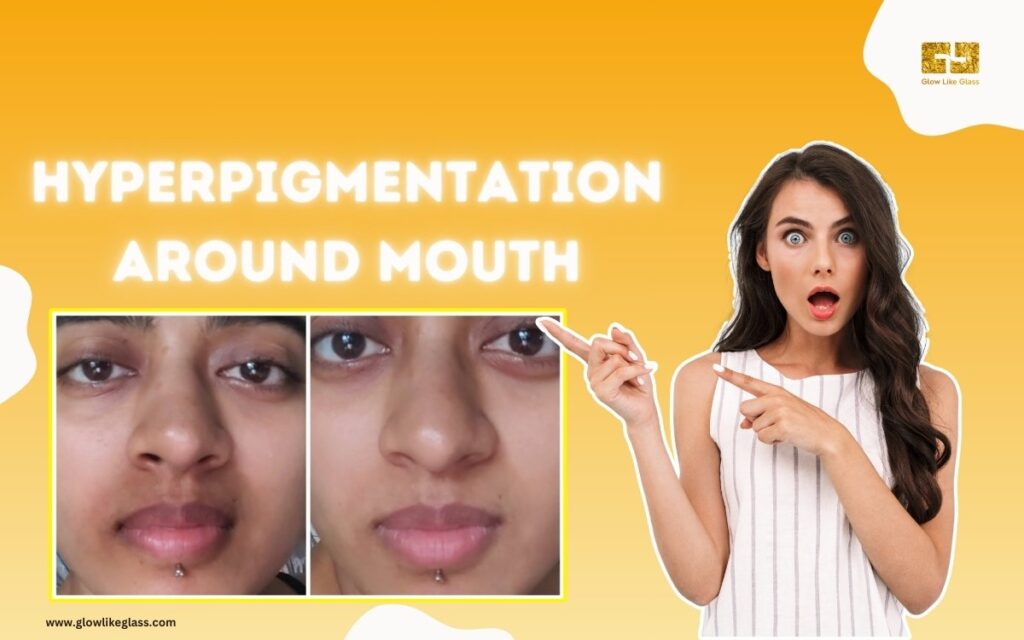 Hyperpigmentation Around Mouth